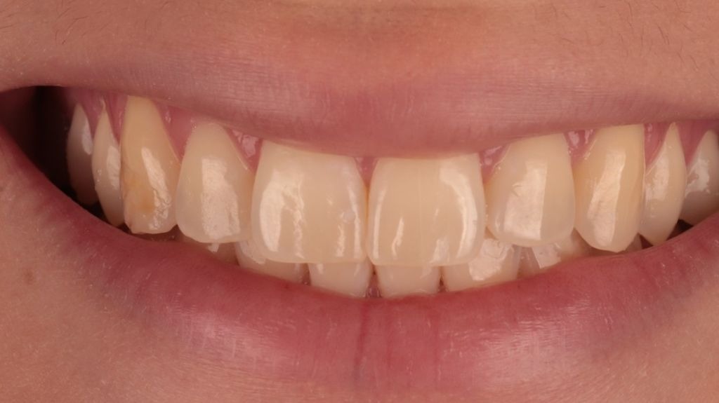 Sorriso antes do clareamento dental supervisionado