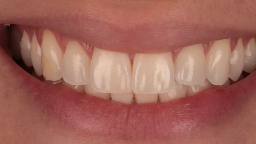 Sorriso iluminado e clareado com preservação da naturalidade
