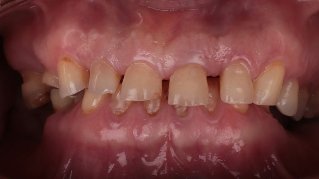 Desgaste dentário severo antes do tratamento reabilitador