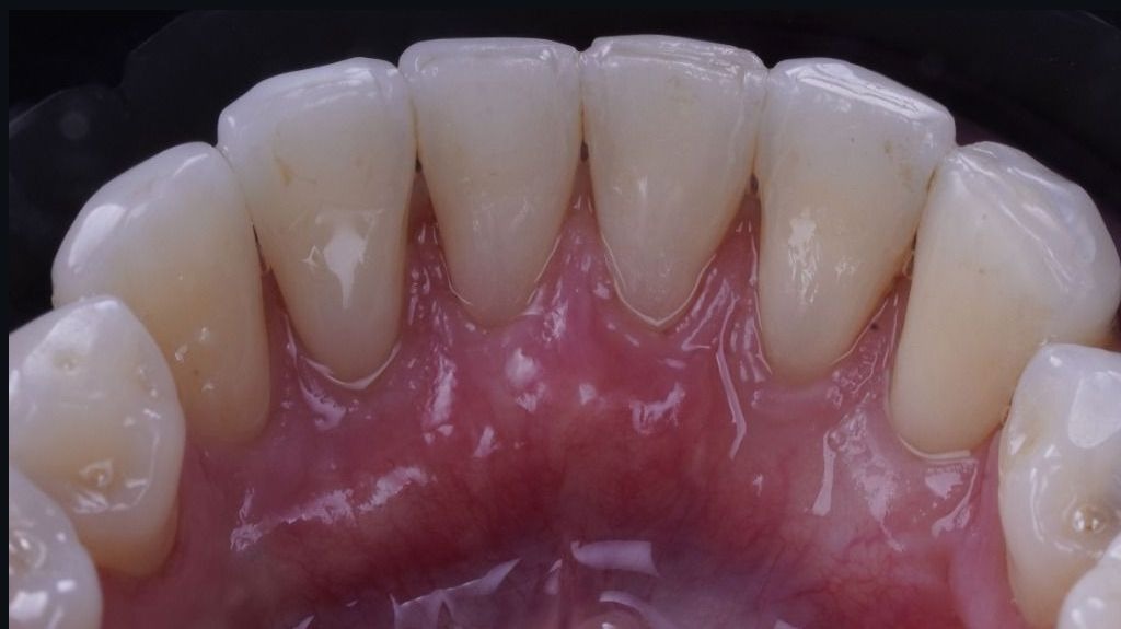 Espessamento tecidual e raízes protegidas após cirurgia plástica periodontal