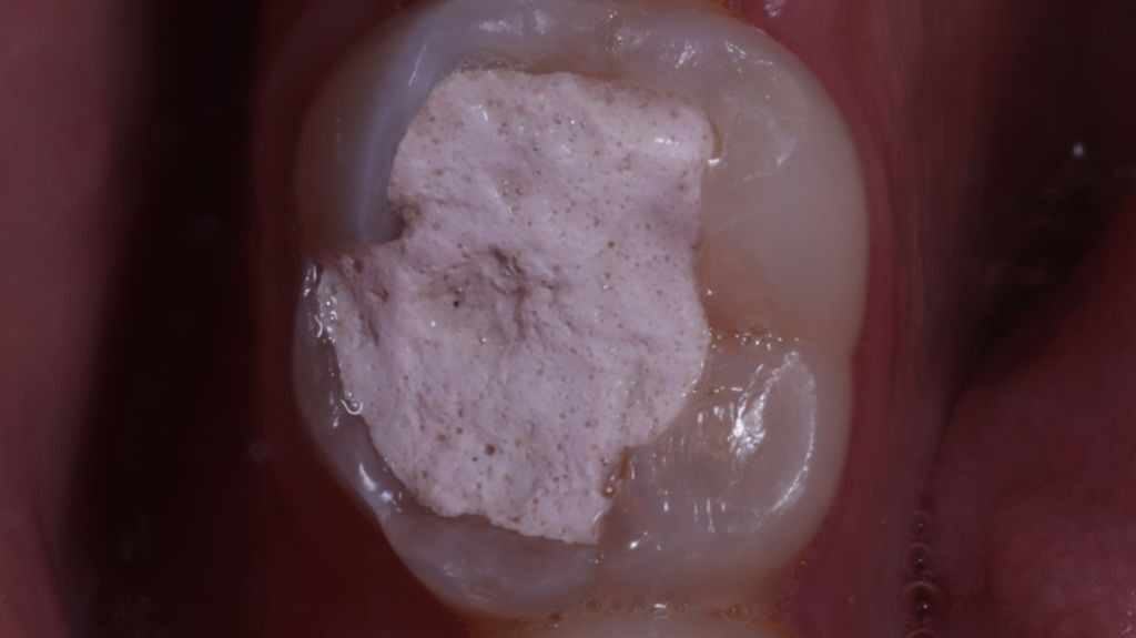 Dente preparado com restauração provisória oclusal