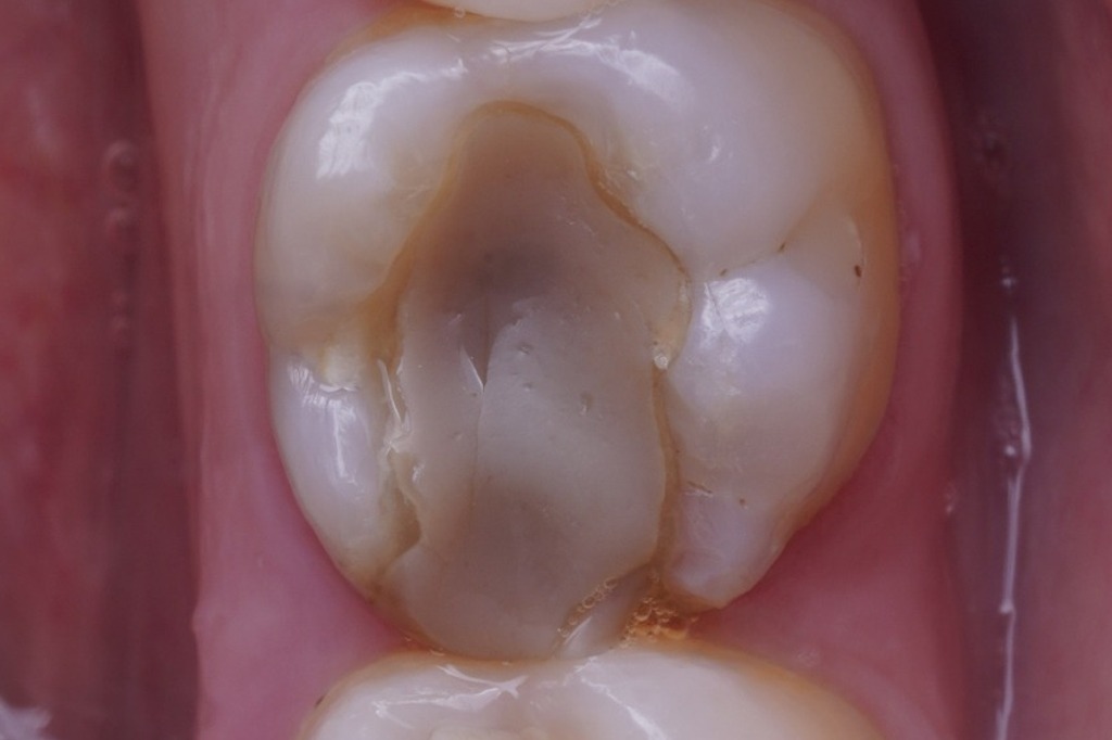 Restauração oclusal antiga antes do procedimento