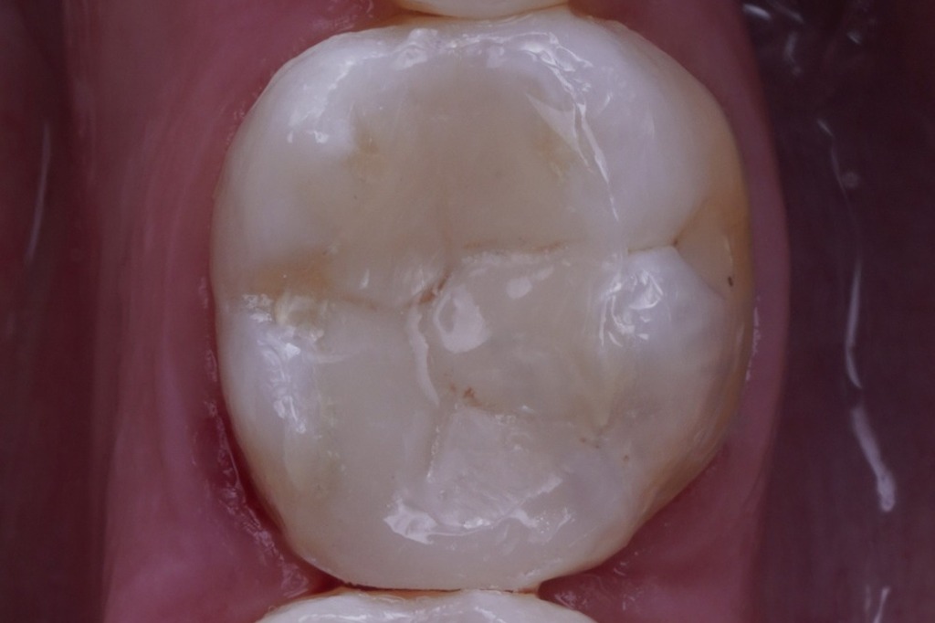 Restauração direta em resina com escultura e anatomia oclusal restabelecidas